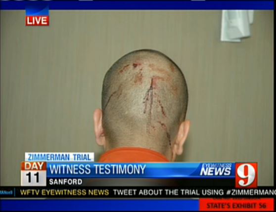 Zimmerman Trial State's Exhibit 56 - back of Zimmerman head